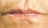 Juvederm