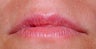 Juvederm