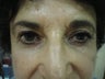 Juvederm