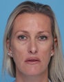 Juvederm