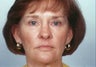 Laser resurfacing