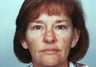 Laser resurfacing
