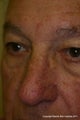 Laser treatment