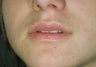 Lip augmentation