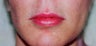 Lip augmentation