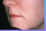 Lip augmentation