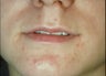 Lip augmentation