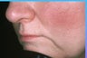 Lip augmentation