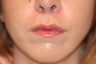 Lip lift