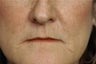Lip lift