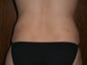 Liposculpture