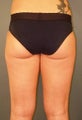 Liposculpture