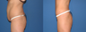 Liposuction