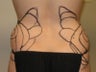 Liposculpture