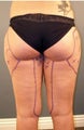 Liposculpture