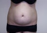 Liposculpture