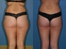 Liposuction