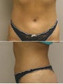 Liposuction