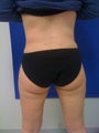 Liposuction