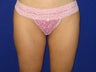 Liposuction