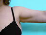 Liposuction