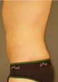 Liposuction