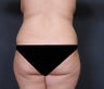 Liposuction