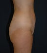 Liposuction