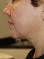 Tumescent liposuction