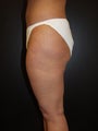 Liposuction