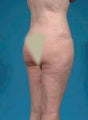 Liposuction