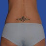 Liposuction