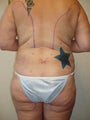 Liposuction