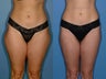 Liposuction