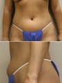 Liposuction