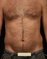 Liposuction