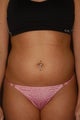 Liposuction