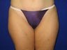 Liposuction