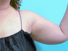 Liposuction