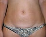 Liposuction