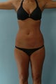 Liposuction