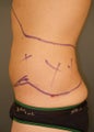Liposuction