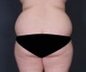 Liposuction