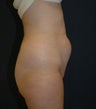 Liposuction