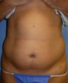 Liposuction