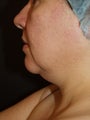 Tumescent liposuction