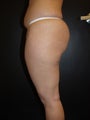 Liposuction