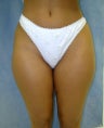 Liposuction