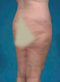 Liposuction
