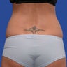 Liposuction